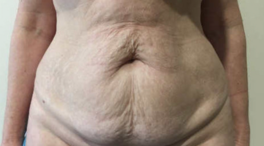 Beneficios De La Autofagia En la Piel Flácida | ¿Reafirma tu piel?