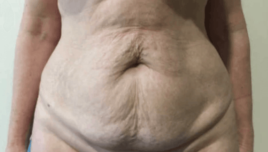 Autophagy and Loose Skin: Your Pathway to Tighter, Healthier Skin